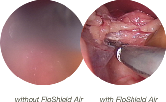 Laparoscope view with and without FloShield Air